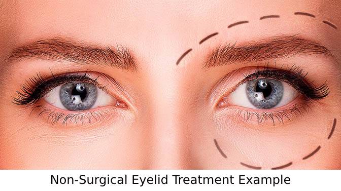 Non Surgical Eyelied Treatments